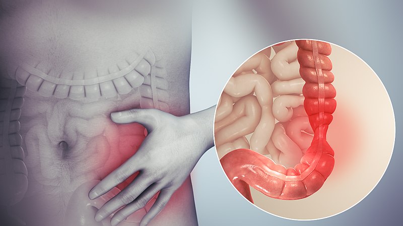 colon cancer treatment In Indore, gastroenterologist in indore